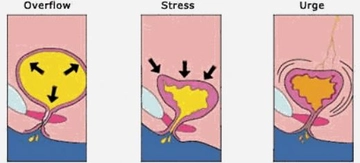 Stres İnkontinans Tedavisi